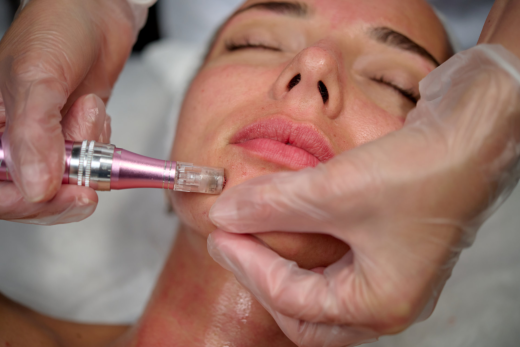 Micro-Needling: What Is It and What Are Its Benefits?